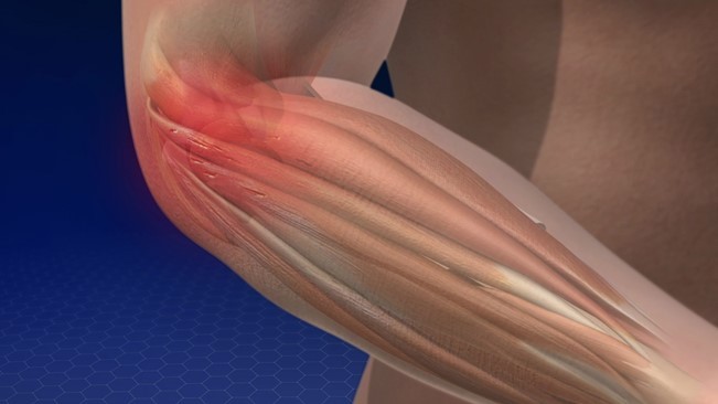 Tennis Elbow